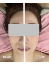 ハナ トータル ケア(Hana Total Care)/ヘッドスパでリフティング効果