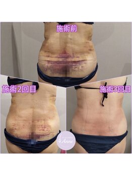 アン(Anne)/【術後ケア】インディバボディ