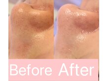 リンダ 西宮店(LINDA)/ハイドロ×プラズマ