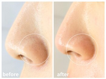 ラミーユ(La Miu)/1度の施術で毛穴汚れが改善