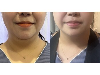 アニス/顔周りの要らないお肉撃退