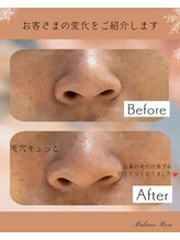 マハローレン(Mahalo Ren)/毛穴Before after