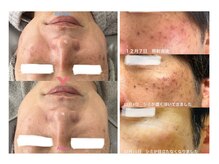 アレイズ(ARAYS)/症例(男性)