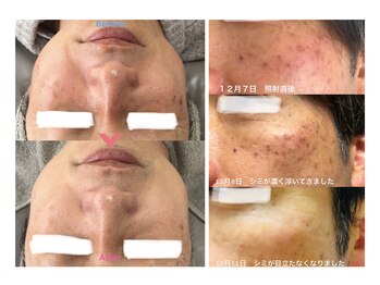 アレイズ(ARAYS)/症例(男性)