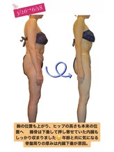 エステティック アントワネット/５２歳女性のビフォーアフター☆