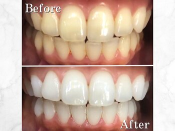 LBSホワイトニング 銀座店/継続して白い歯へ