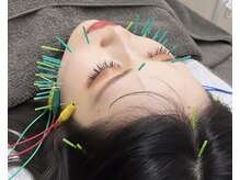 ヴィーライン 恵比寿本院(VeLine)/形状記憶美容鍼