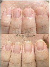 マリーロール 天王寺店(Marie Laure)/自爪育成/深爪矯正/ネイルケア