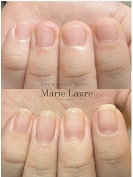 マリーロール 天王寺店(Marie Laure)/自爪育成/深爪矯正/ネイルケア