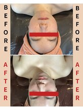 ハレアンド(Hare&)/ブライダル小顔コルギ