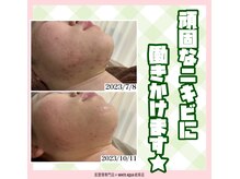 ホワイトアクア 岐阜店(WHITE AQUA)/ハーブピーリング/岐阜/毛穴