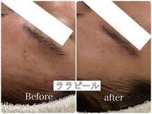 イデアルミー 大宮店(イデアルMe)/1回目施術前・2回目施術後