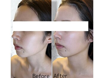 ルミライ(Lumirai)/たるみ改善|毛穴|フェイシャル