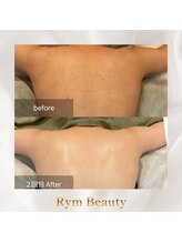 リム ビューティー(RYM BEAUTY)/背中ニキビにボディダクトピール