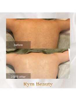 リム ビューティー(RYM BEAUTY)/背中ニキビにボディダクトピール