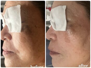 サロン ド ラム/【韓国PDTコース】4回目