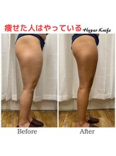 ハリルル 併設 GLケンタ鍼灸整骨院(HARILULU)/集中　下半身痩せ