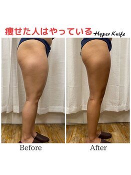 ハリルル 併設 GLケンタ鍼灸整骨院(HARILULU)/集中　下半身痩せ