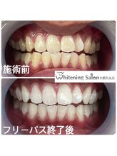 ホワイトニングサロン 京都烏丸店/ホワイトニング施術例