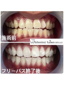 ホワイトニングサロン 京都烏丸店/ホワイトニング施術例