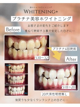 ホワイトニングプラス(Whitening+)/やっぱりプラチナ美容!!