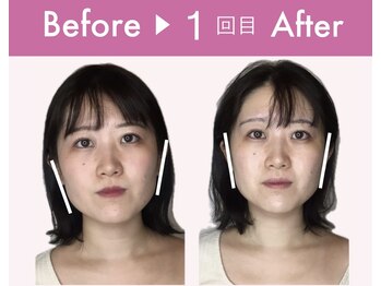 ビジュー(bijoux)/ララピールビフォアフ１回