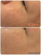 サロンドラニ(salon de LANI)/【シミケア】症例