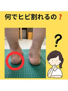 ナカザワ(NAKAZAWA)/カカトの角質・ひび割れの原因