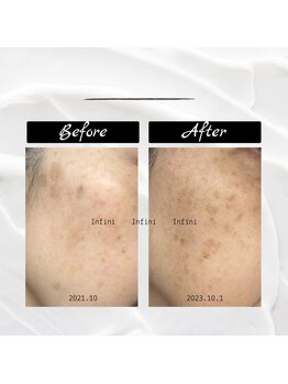 アンフィニ 麻布十番(Infini)/ハーブピーリング/NPVA