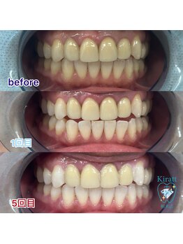 キラット 栃木店(Kiratt)/クリスタルセルフホワイトニング