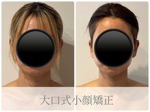 アロラヴィ(AroRavi)/OGUCHI式小顔矯正