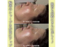 ハニエル(Haniel)/カーボキシー症例