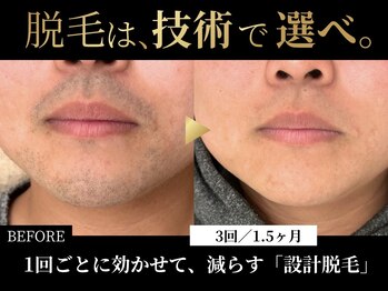 ダイヤ 名古屋中川区店(Daiya)の写真/【症例数エリアNo.1】少ない回数で卒業を目指す、技術で選ぶ大人のメンズ脱毛。|ヒゲ・VIO特化!