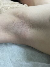 ナノハナ/鹿沼市の全身脱毛のナノハナ