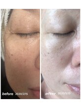 キラリ(Kirari)/【美肌エステ２回/月3ヶ月継続】