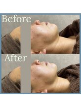 エステ シンセリティー(aesthetic sincerity)/たるみ改善◇毛穴洗浄/シミケア