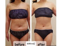 ICI サロン シンパシー イオン店(ICI Salon Sympathy)/Wキャビテーション