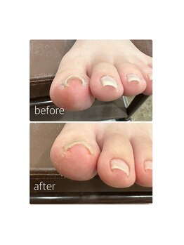 ゾゾ イリプレッセブル(ZOZO irreplaceable)/巻爪補正の施術例