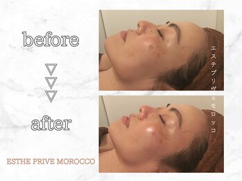 エステプリヴェモロッコ(ESTHE PRIVE MOROCCO)/WIQOコラーゲンピール