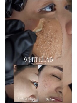 ルミア(LUMIA)/最新シミケア☆シミの消しゴム