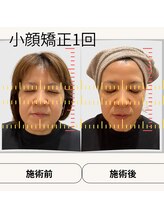 ボディトーン(bodytone)/小顔矯正×フェイシャルの効果２