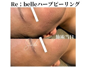 サラ/Re:belleハーブピーリング