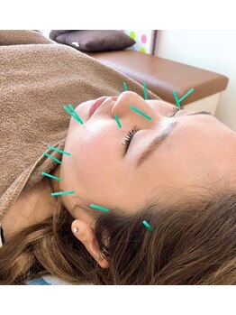 宇宿鍼灸整骨院/鍼灸【美容鍼】