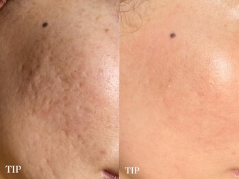 ダリア(Dahlia)/TIPならニキビ改善に効果あり！