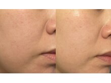 ビーメイクス(B・Makes)/ハイドラ洗浄