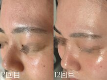 ウィハナ(wehana)/【ララピール】肌管理/水光肌