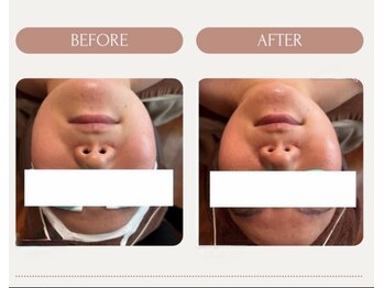 マオ(mao)/☆1回Before→after☆