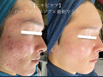 ソリッジ肌管理室の写真/【お肌の土台作りをしっかりケア】お肌のターンオーバーを整えて、内側から艶プル透明肌に♪お化粧ノリも◎