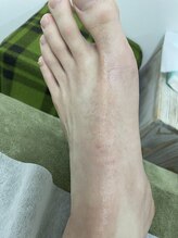 ナノハナ/鹿沼市の全身脱毛のナノハナ