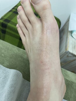 ナノハナ/鹿沼市の全身脱毛のナノハナ